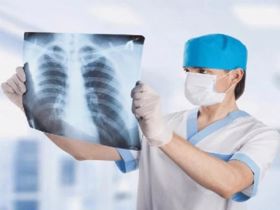 Làm sao để giảm nguy cơ tái phát bệnh u phổi sau điều trị?